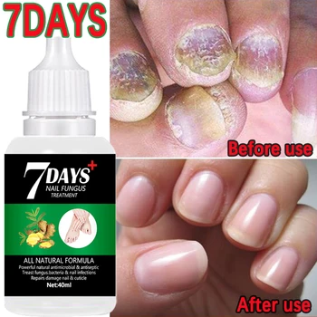 7days mână-picior ciuperca unghiilor tratament tratamentul unghiilor ciuperca picior de îngrijire a unghiilor esența anti-infecțios paronichie onychomycosis